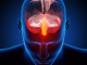 New Drug Treatment For Migraines Is Like A Miracle